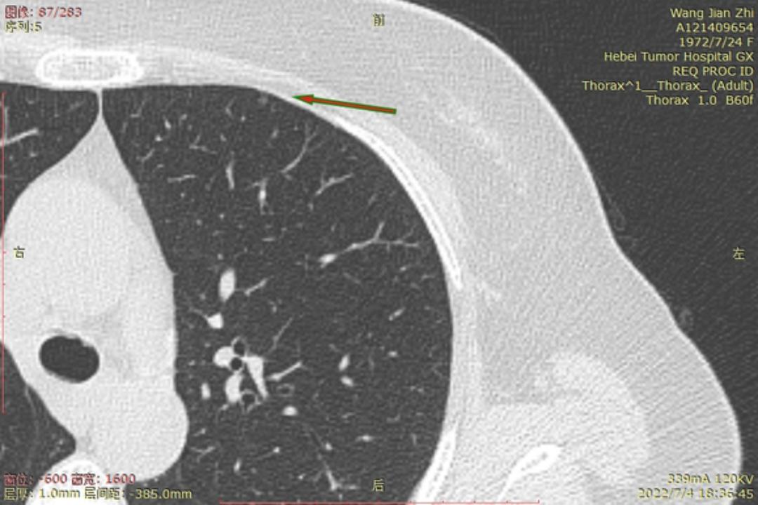 首次发现磨玻璃结节要吃药消炎吗,磨玻璃结节警惕合并占位