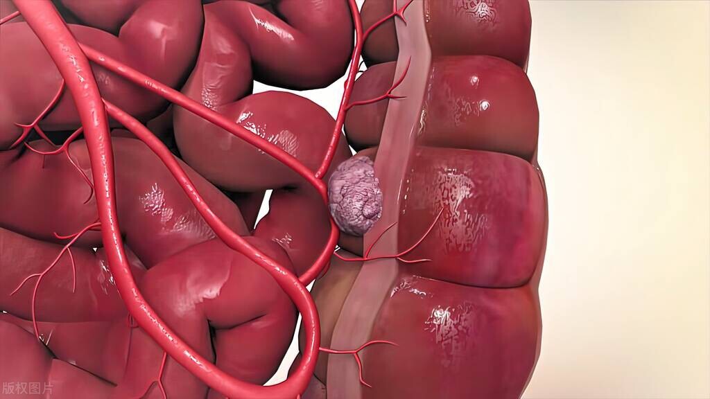 肠癌的中医辨证分型,中医是否有治疗肠癌的药方