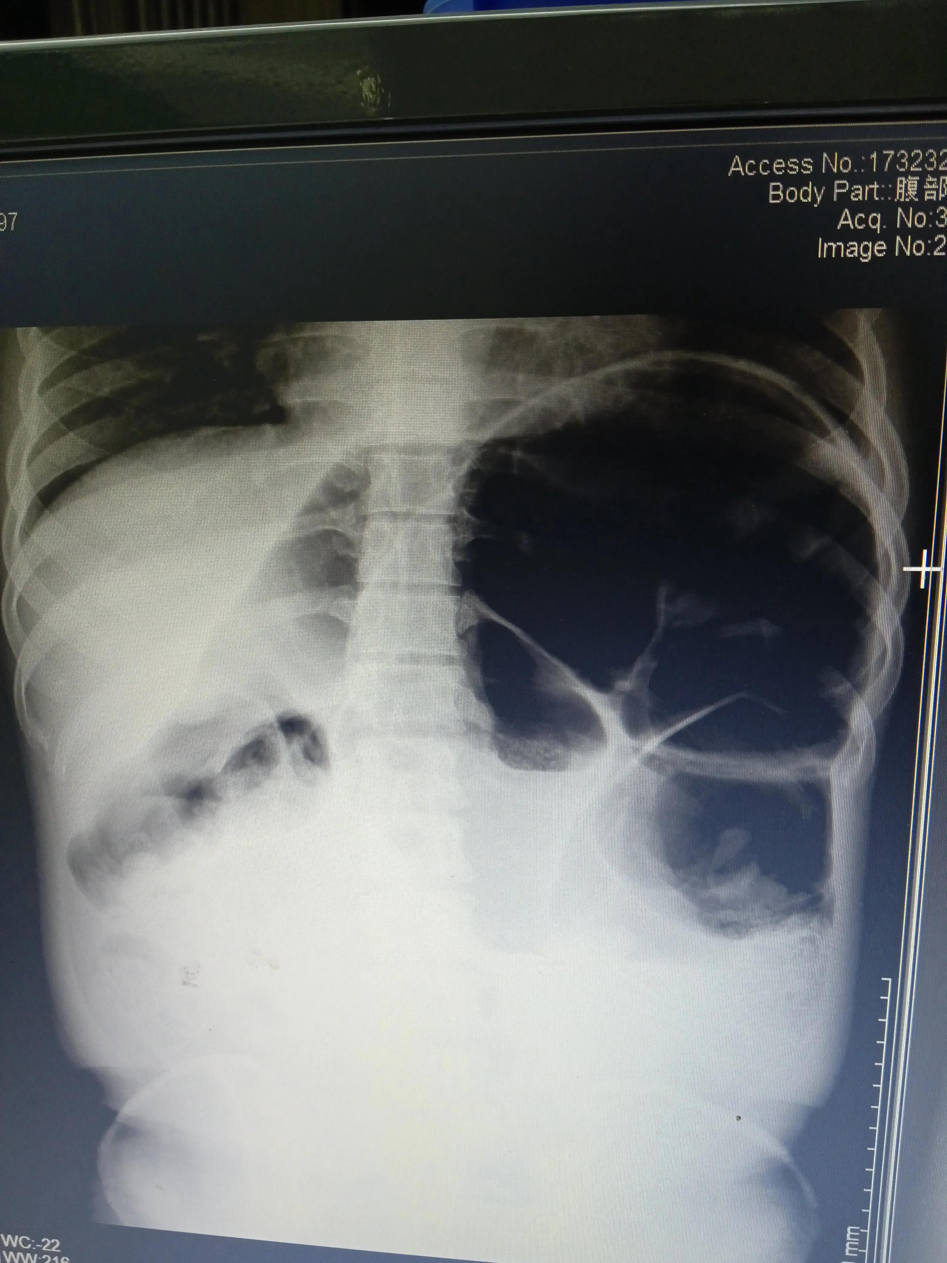 肠梗阻引起胃不舒服怎么办,肠梗阻的症状及治疗长期不排便