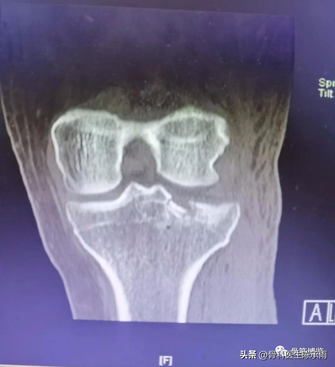 膝关节胫骨平台骨折,最近胫骨平台骨折视频