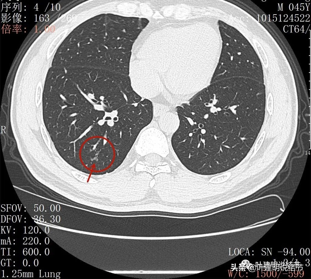 误诊肺纤维化,肺蜂窝状是癌吗