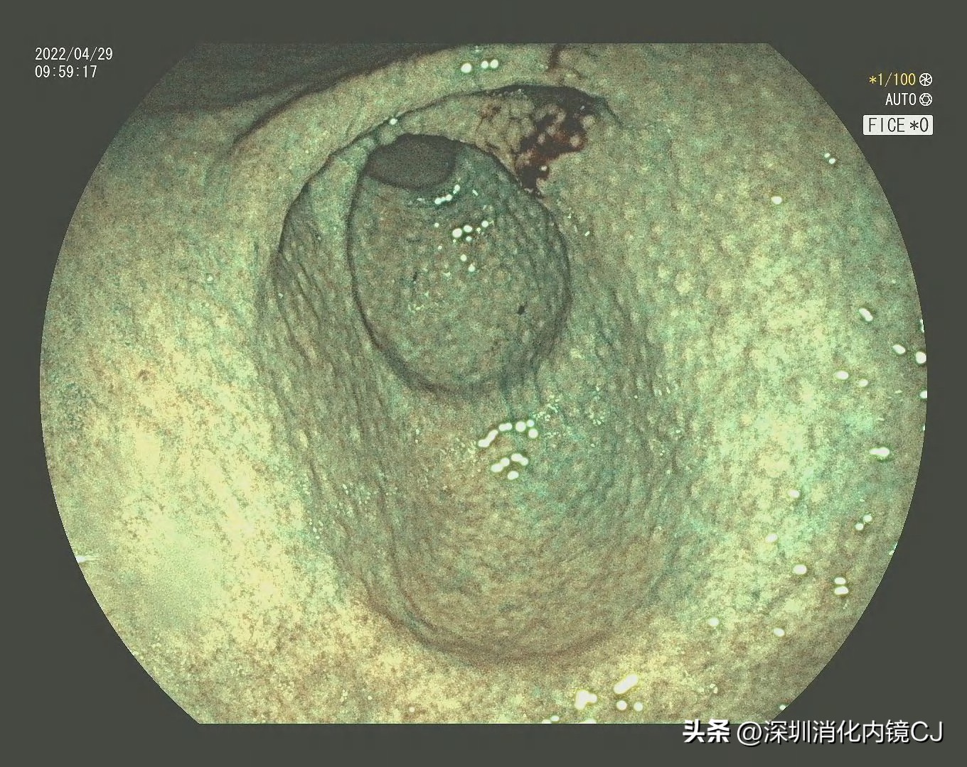 幽门螺旋杆菌感染胃粘膜表现,没有幽门杆菌但是胃窦鸡皮样改变