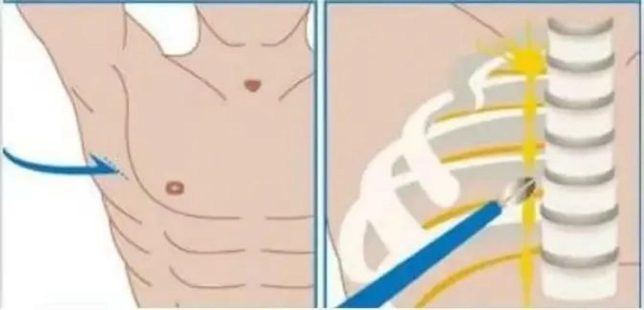 手心出汗是怎么回事怎样治疗,手汗症出汗特别严重用什么能止汗