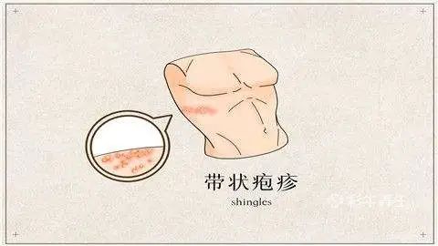 带状疱疹皮疹消了火辣辣的痛,带状疱疹好了后皮疹反复出现