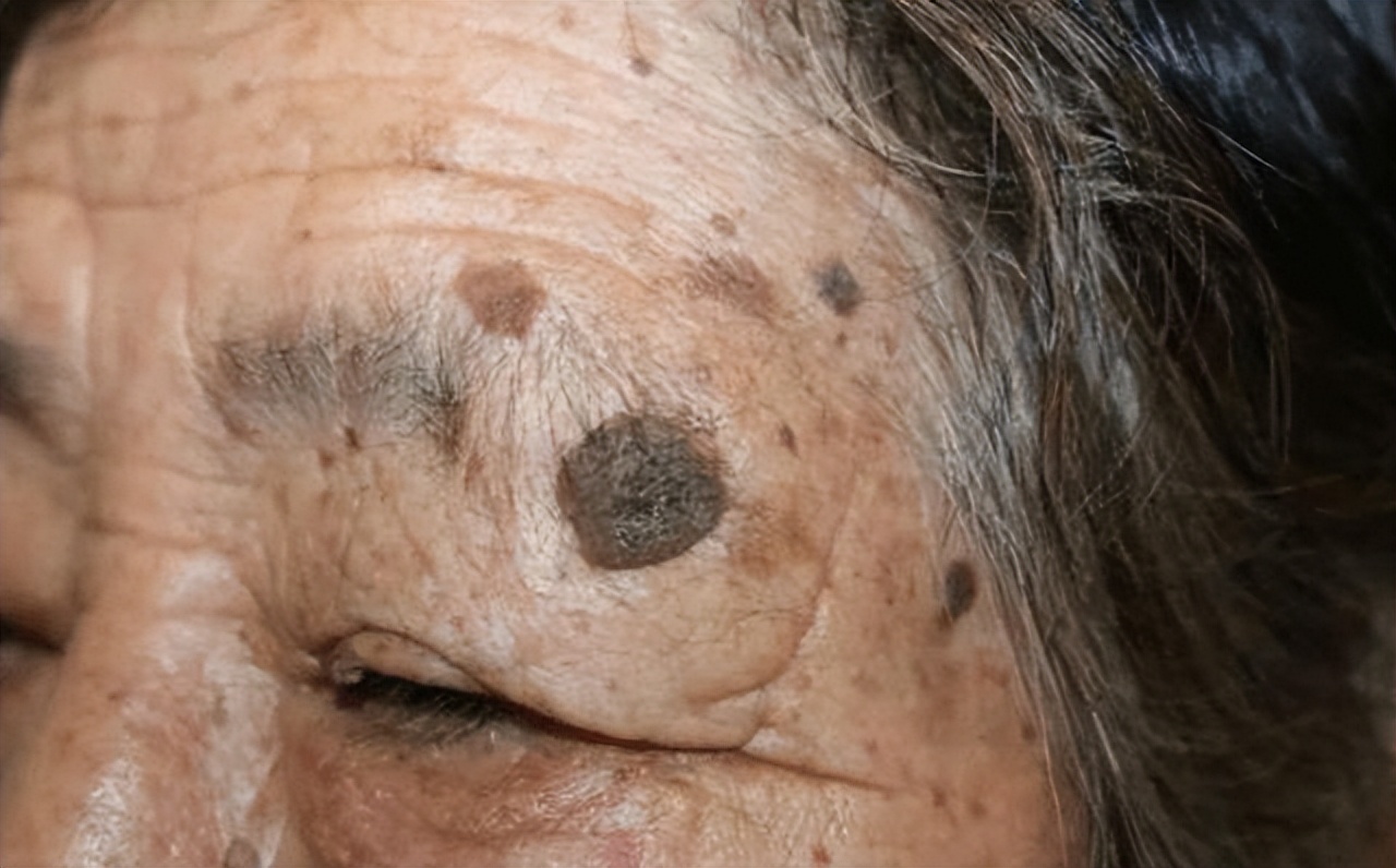 老年斑破损用红霉素软膏有效吗,红霉素软膏和开塞露能祛老年斑吗