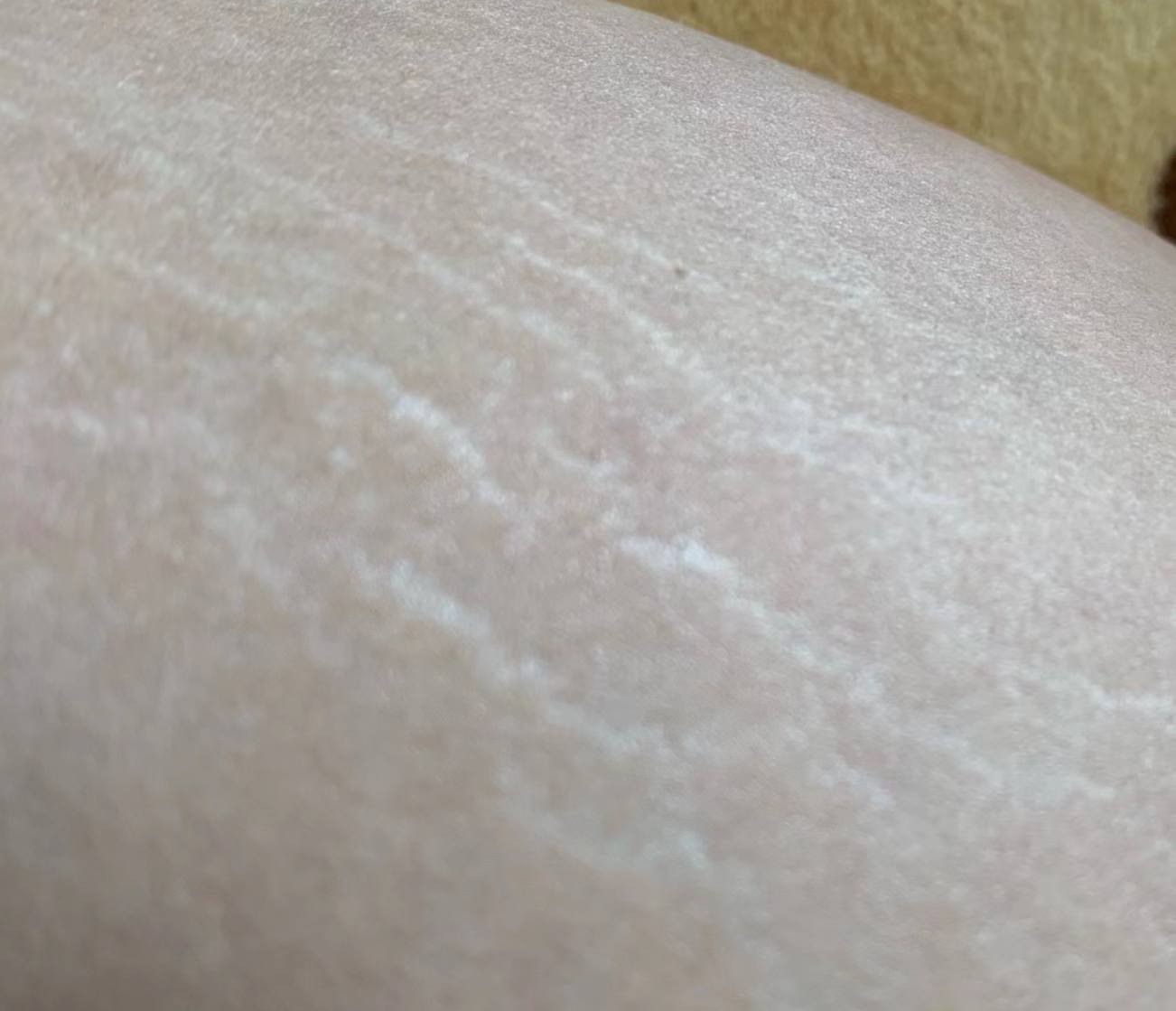 肥胖纹目前最好的去除办法,淡化肥胖纹修复肥胖纹