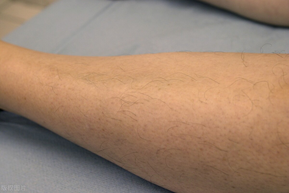 米诺地尔治疗脱发的作用机制,米诺地尔真的能治疗脱发吗