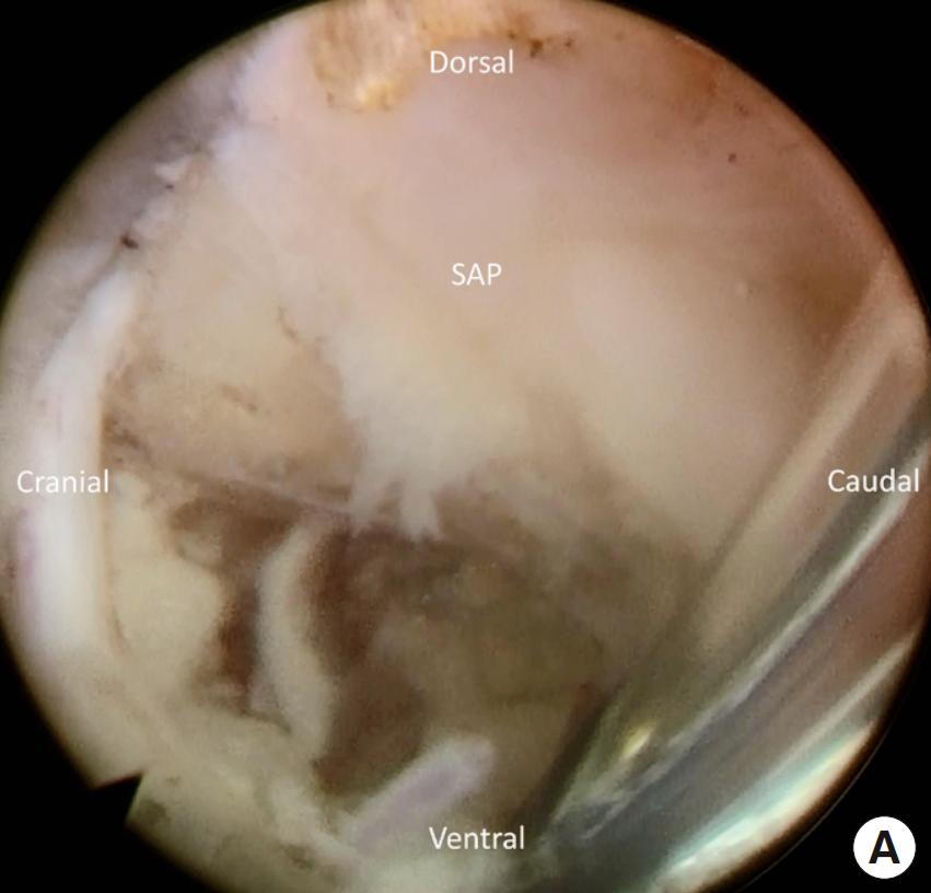 椎间孔镜微创介入治疗椎间盘突出,腰3-4椎间盘突出针刀治疗