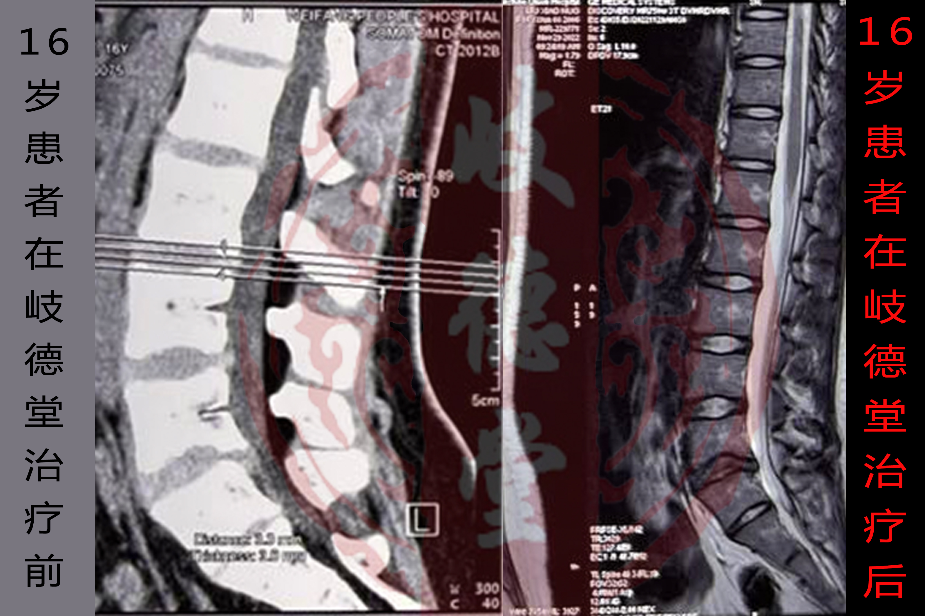 【案例分享】16岁腰椎滑脱患者的康复案例