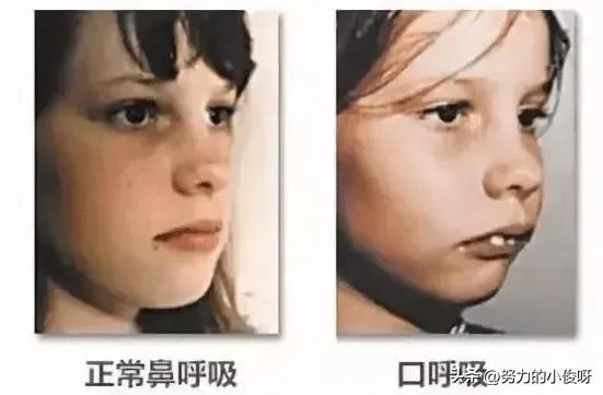 嘴凸怎么改善最有效果,23岁改变口呼吸可以改善嘴凸吗