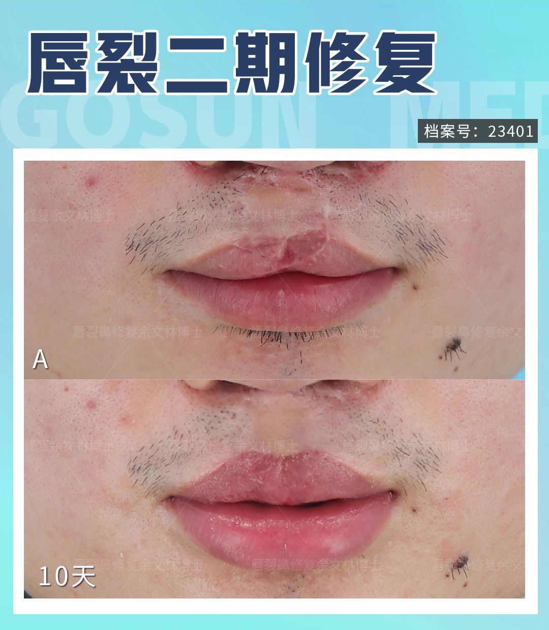 一期二期唇裂修复,轻度唇裂修复后会留疤吗