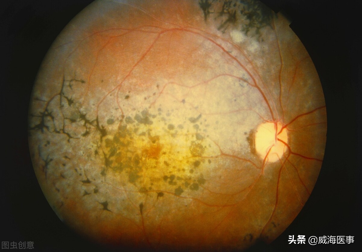 现代基因能治疗视网膜色素变性吗,基因疗法视网膜色素变性新进展
