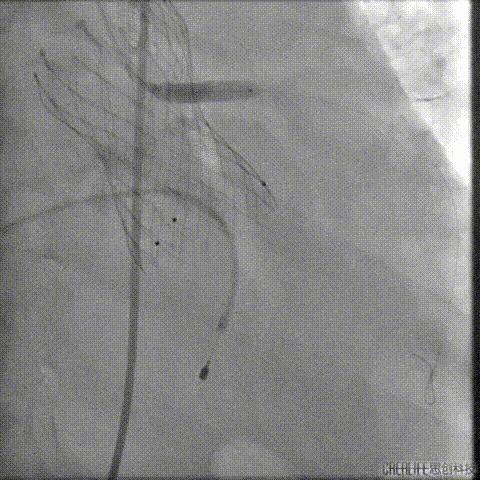 病例回顾与分享,腹膜后血肿介入治疗