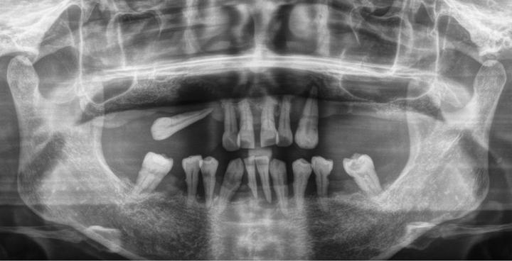 种牙医生说种牙过程,种植牙技术有几种方法
