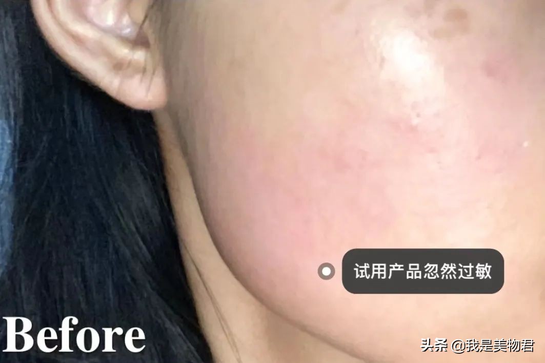 春敏的最佳治疗方法,春敏自救小妙招