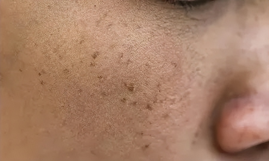 夏天怎样去除晒斑,如何防止夏季雀斑加深