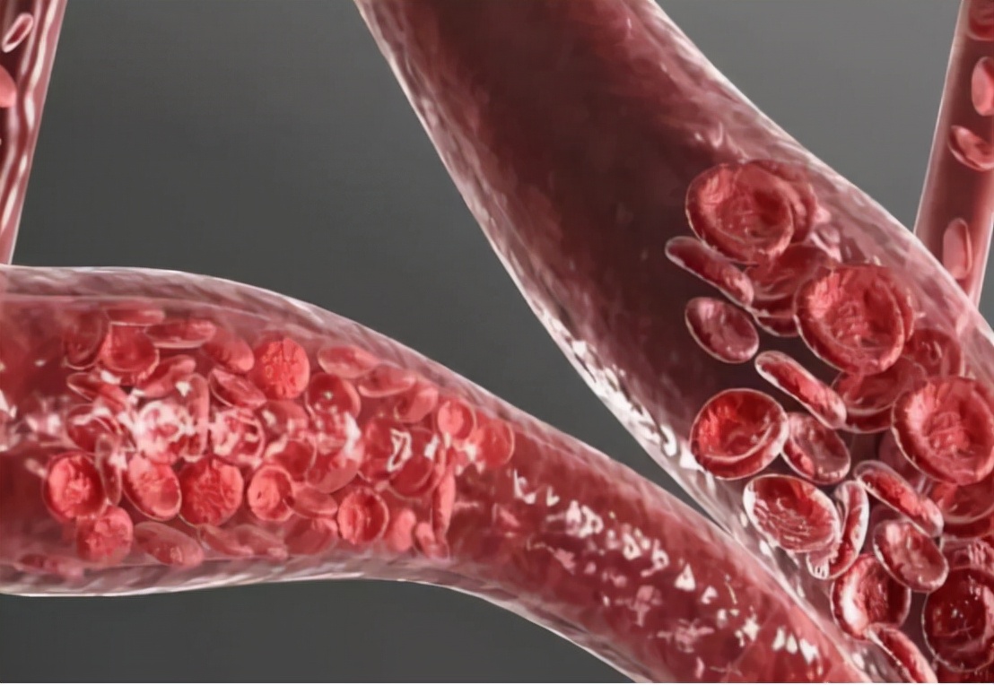 补充叶酸和维生素B6，可有效预防脑梗死，科学服用注意4点