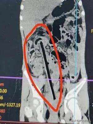 老人不慎从楼梯上重重摔下,老人意外从楼上摔下来