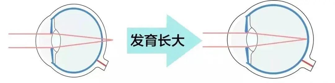 近视了不能矫正到1.0为啥视力模糊,近视矫正后遗症会一直存在吗