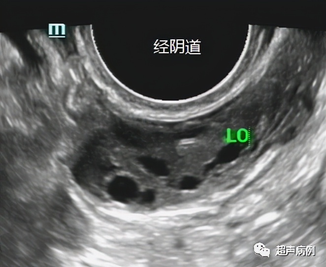 做阴道B超是一种什么样的体验?