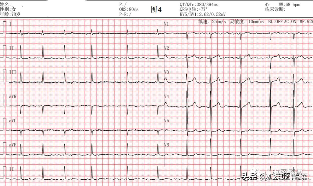 灏忓効蹇冩埧棰ゅ姩,蹇冩埧棰ゅ姩璇句欢