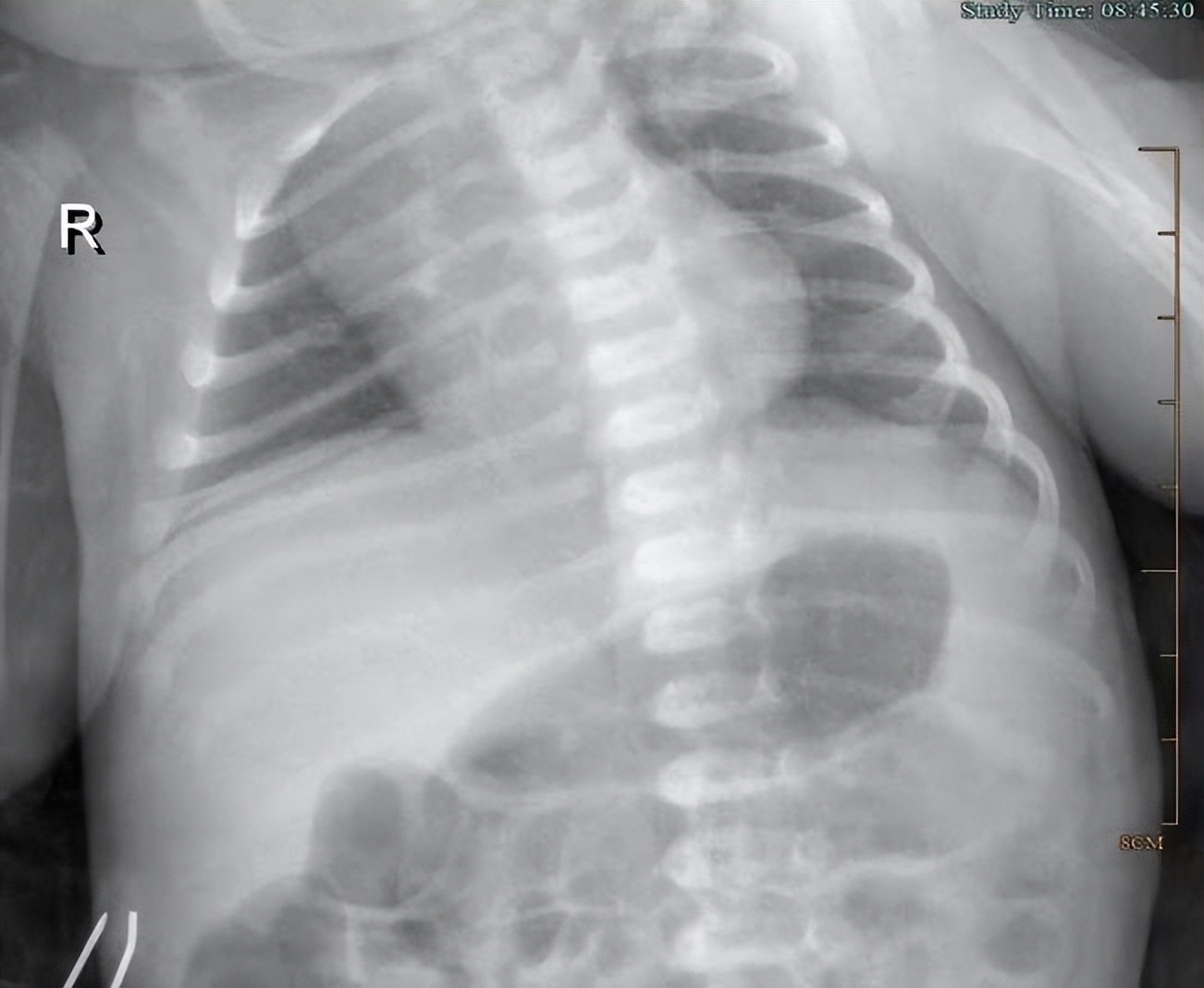 新生儿肺炎抗感染治疗需要多久,新生儿病毒肺炎多长时间才能痊愈
