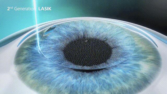 飞秒激光近视手术大概需要多少钱,近视矫正手术安全