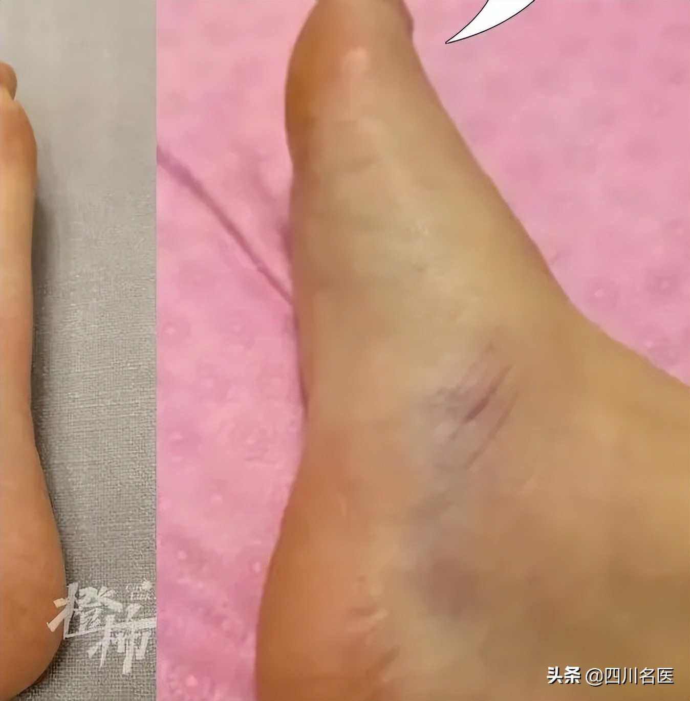 刘畊宏女孩必练的核心动作,刘畊宏女孩进骨科