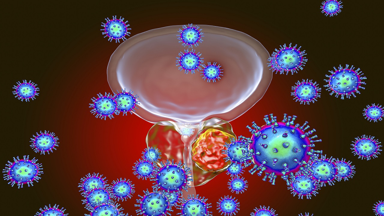 怎样有效预防前列腺癌发生,正确生活方式有助预防前列腺癌