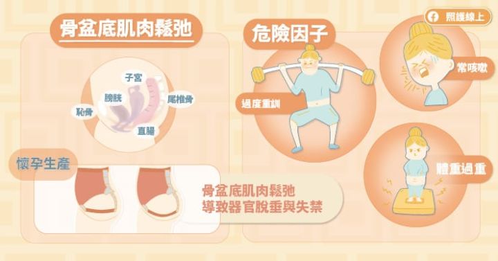 练凯格尔运动真的紧吗,凯格尔运动女生教程