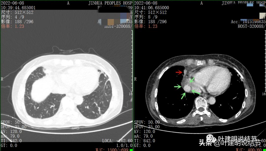 这位老乡，乏力来查，查出这么大个的纵隔肿瘤！会是什么呢？