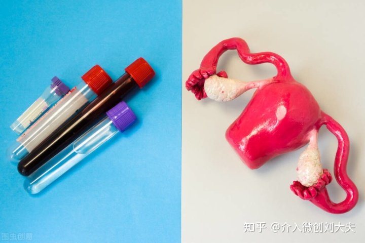 超声介入穿刺治疗巧克力囊肿,介入卵巢巧克力囊肿