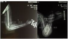 肱骨骨折取钢板怎样恢复,肱骨近端骨折切开复位内固定术