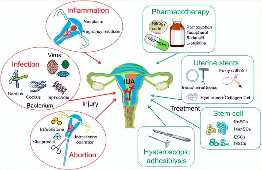 临床适应症｜干细胞对于薄型子宫内膜的修复作用及其临床意义