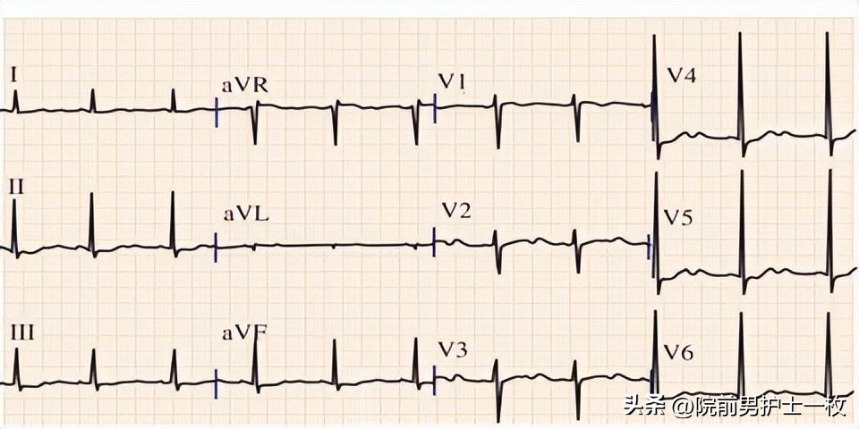 低钾性周期性麻痹怎么补钾,低钾老人吃哪些食物可以补钾啊