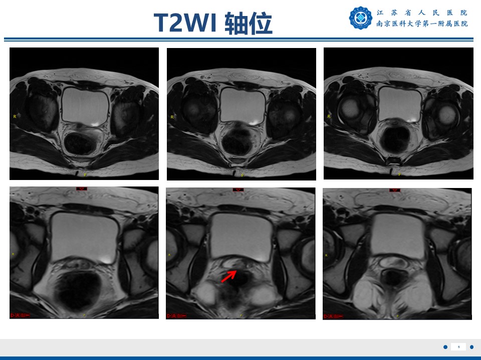 好文分享——《胚胎型横纹肌肉瘤》