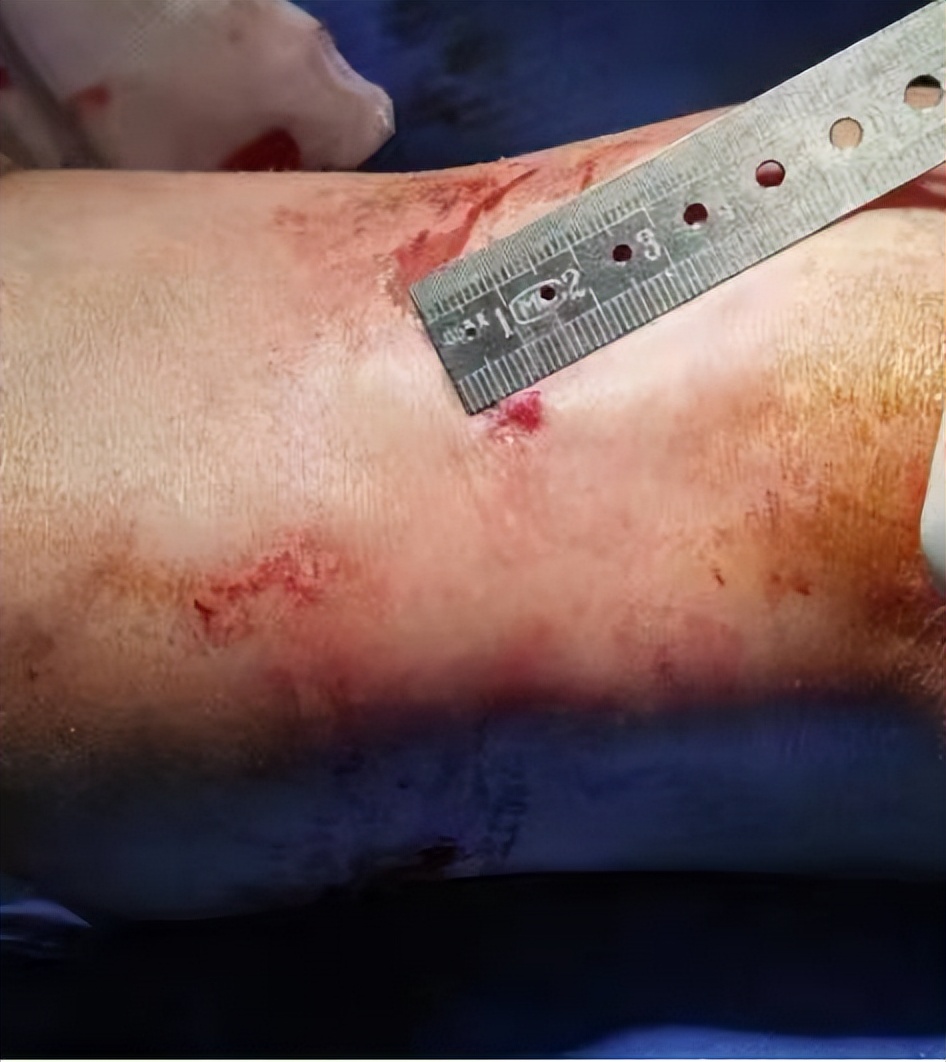 怎么做才能快速治愈膝关节炎,治疗膝骨关节炎最新技术