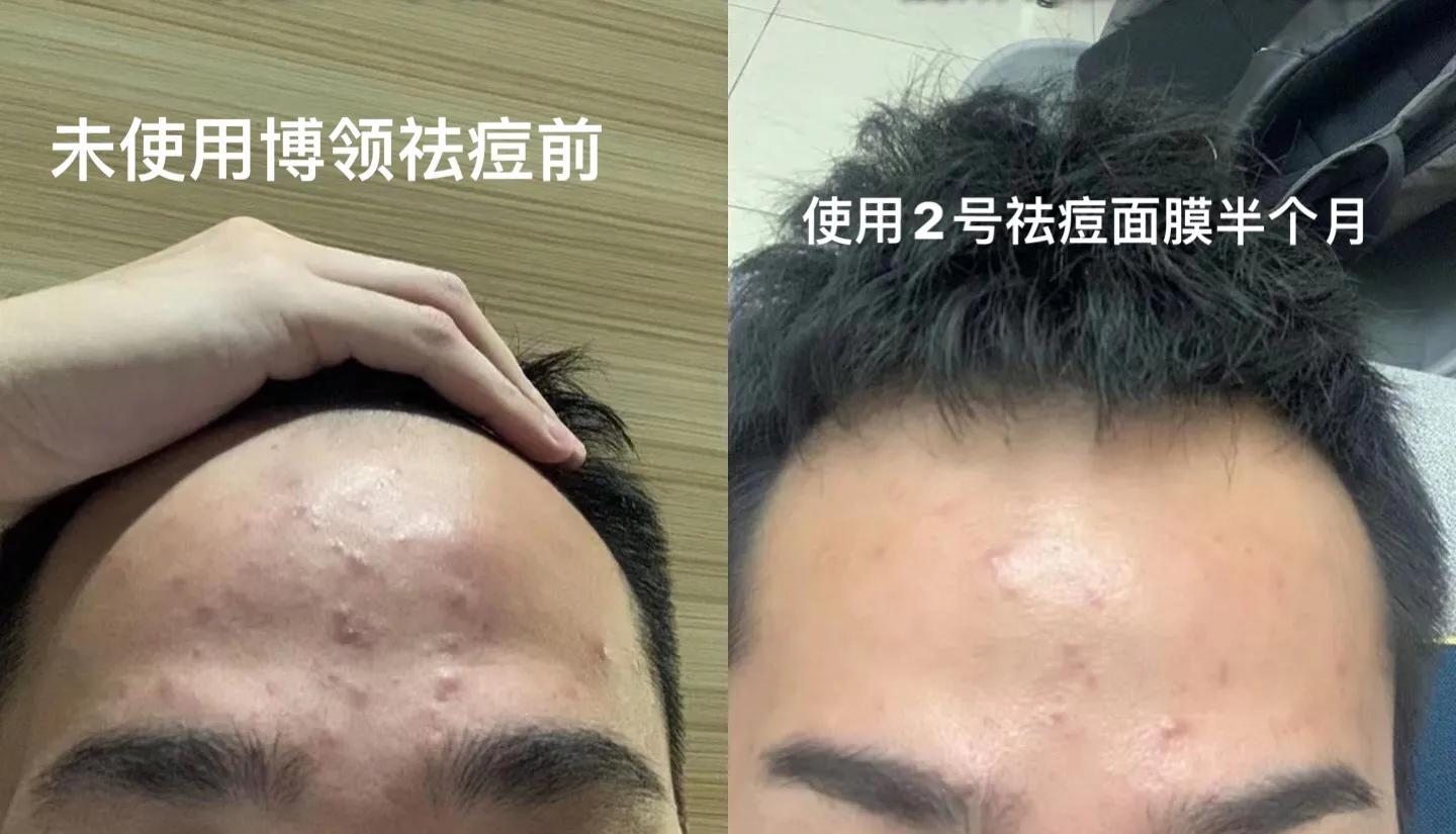 男生怎么祛痘印有效啊,祛痘印痘坑修复男生