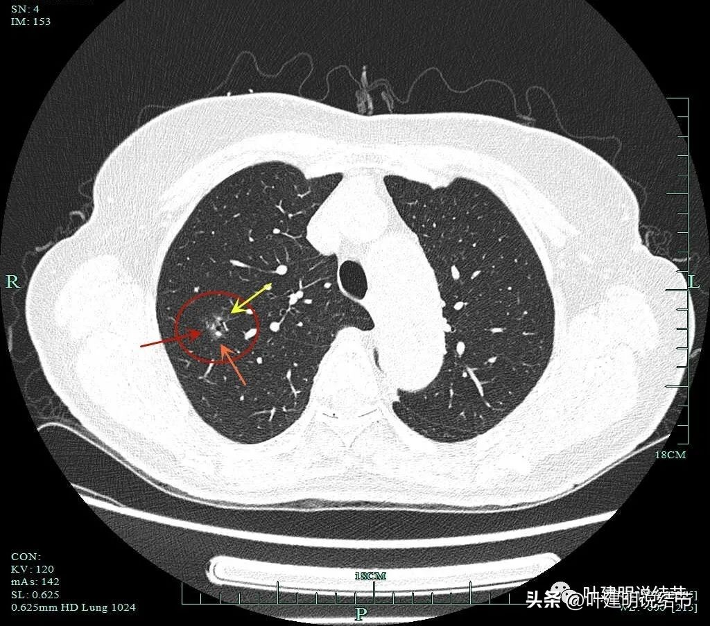 肺楔形切除肺功能降低,肺楔形切除需要缝合吗
