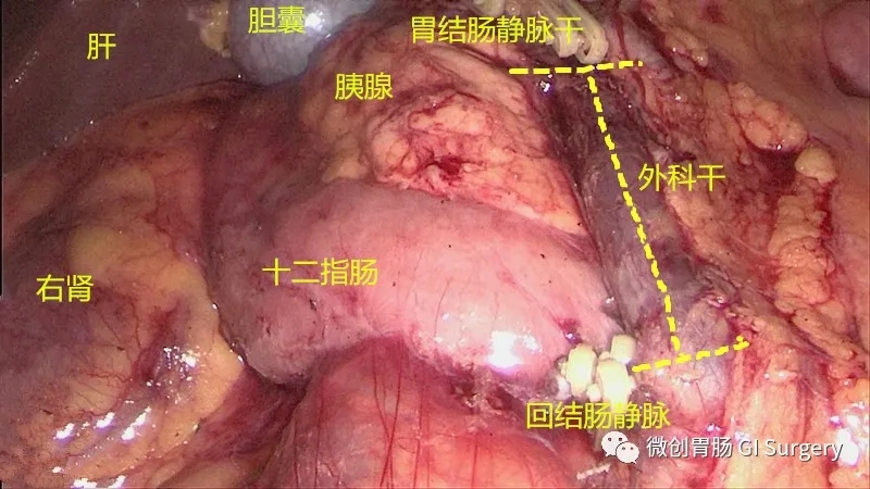 腹腔镜下右半结肠切除术（右半结肠癌的手术方式介绍）