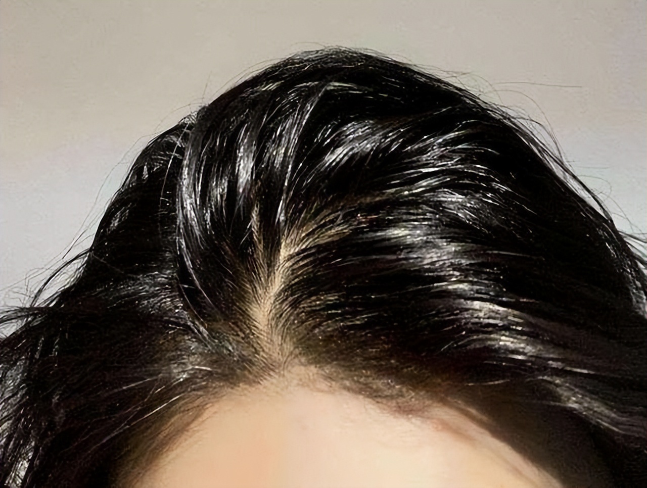 头皮上长红疙瘩脓包头皮屑特别多,头皮总是长疙瘩或脓包是什么原因