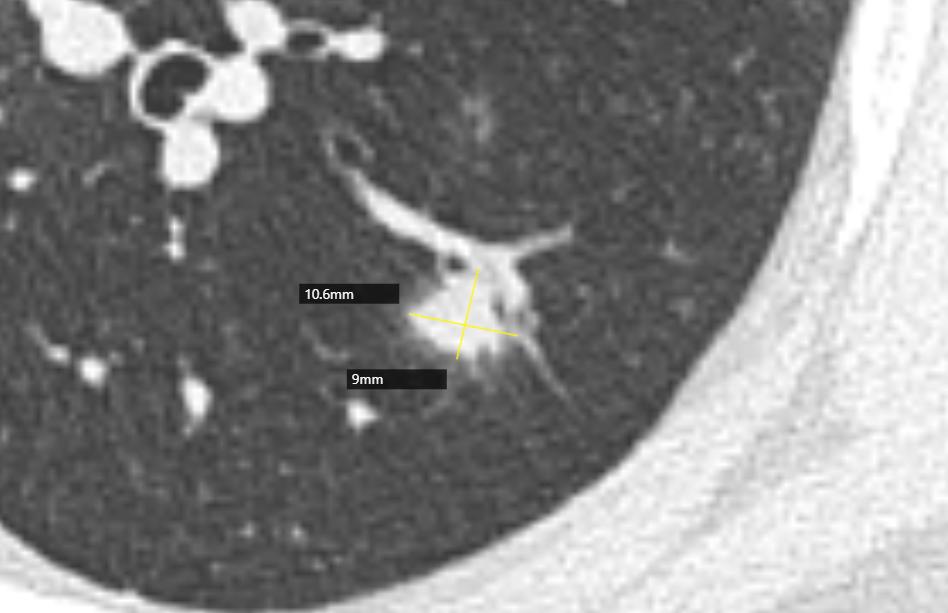 肺结节进一步检查排除肿瘤,肺结节4mm报告建议复查