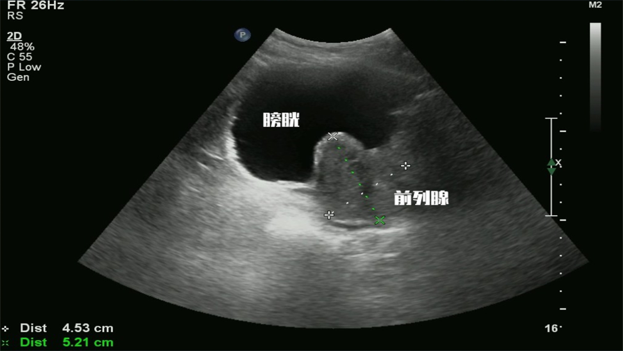 泌尿系统的彩超检查是什么,腹部彩超及泌尿系统彩超注意事项