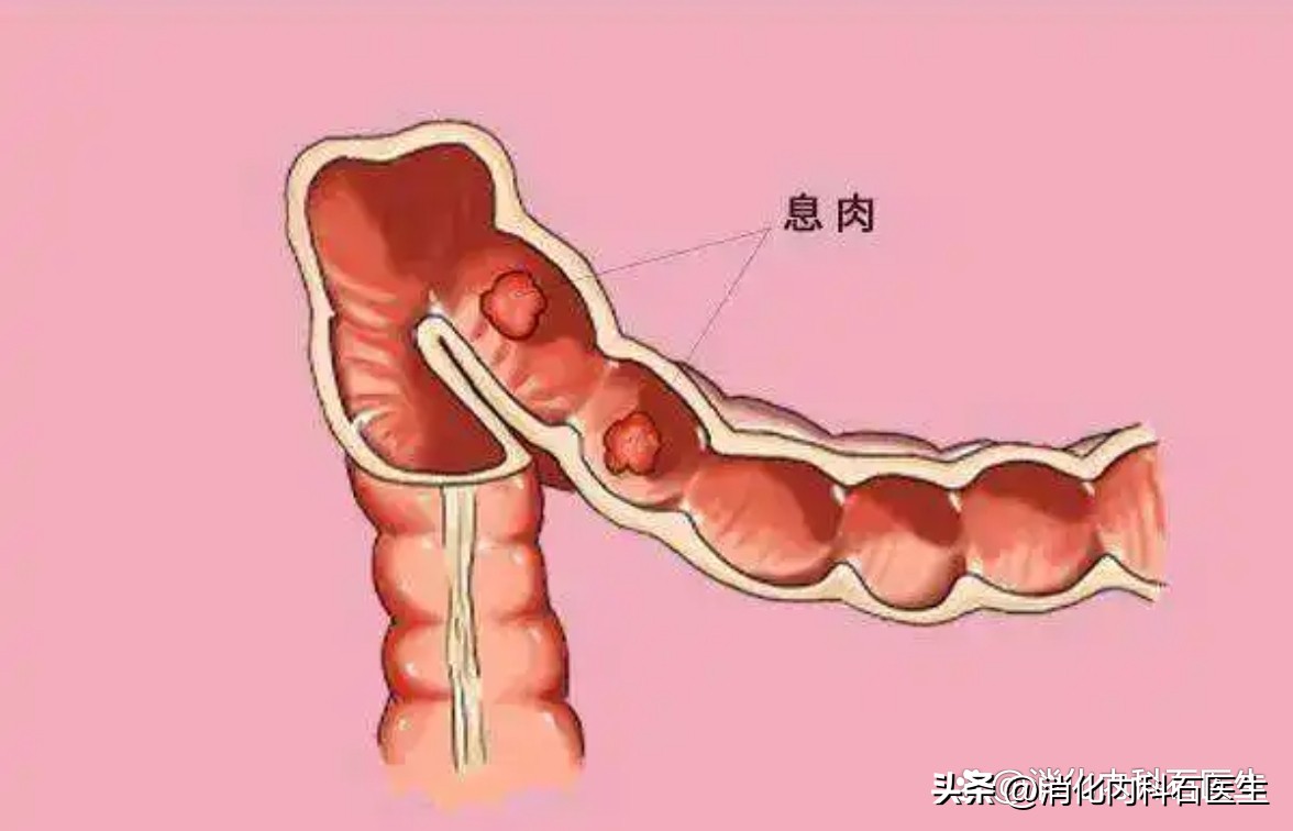 儿童肠息肉2.5公分,小孩结肠息肉用b超能查出来吗