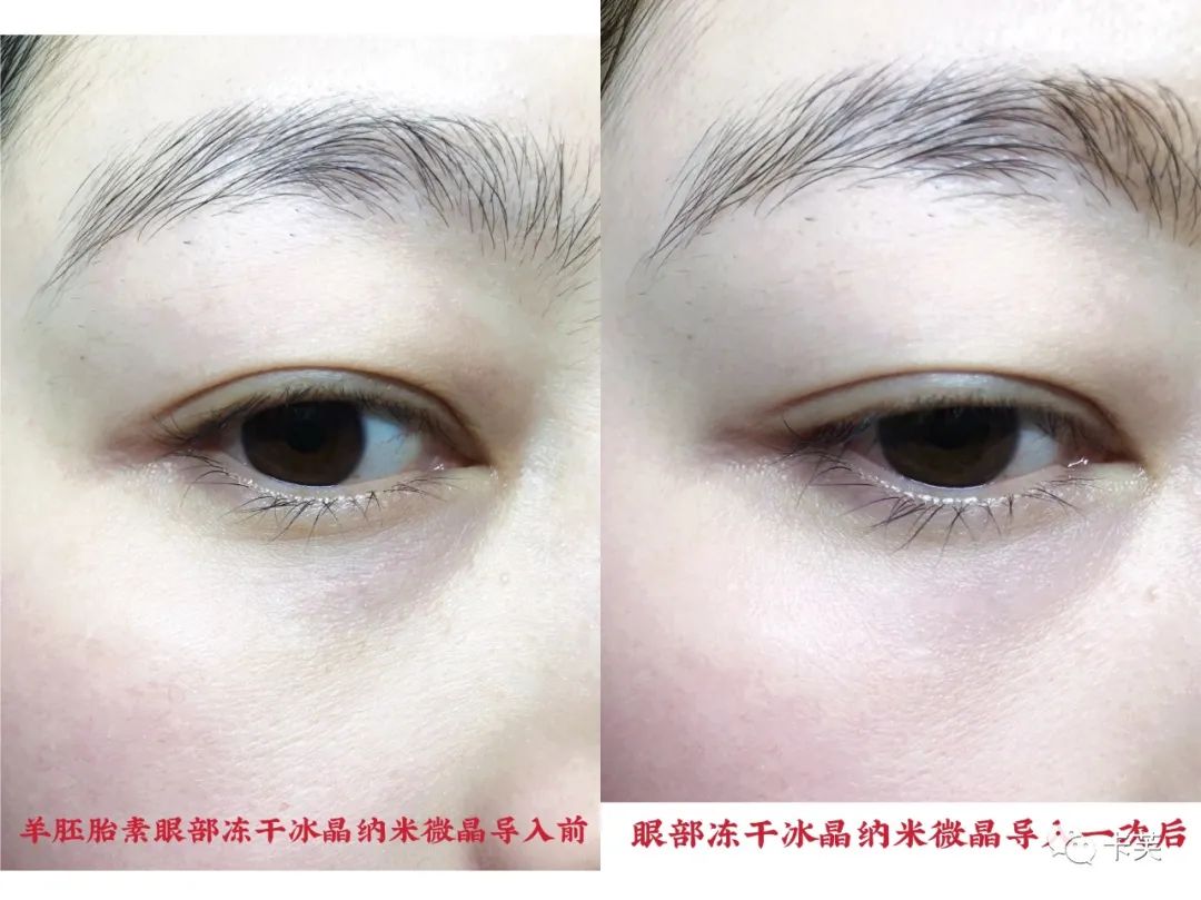 羊胚胎素冻干冰晶眼部精华液，平干纹，淡黑圈，收眼袋，美目传情