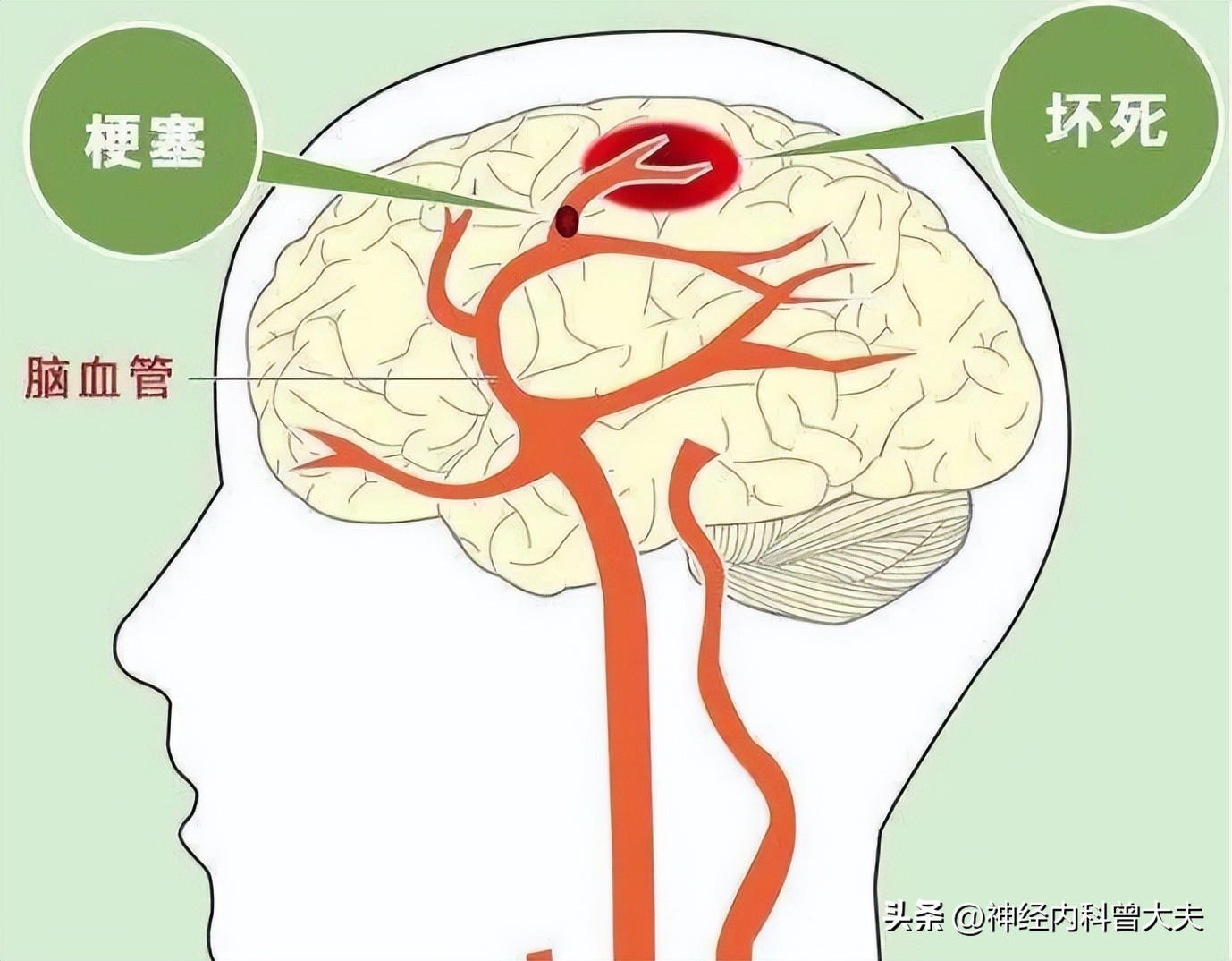 为什么美国脑梗比中国少,欧美为何脑梗病人少