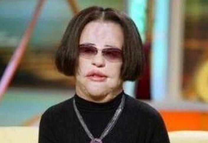 韩慧景整容是打了玻尿酸了吗,韩慧景整容案例