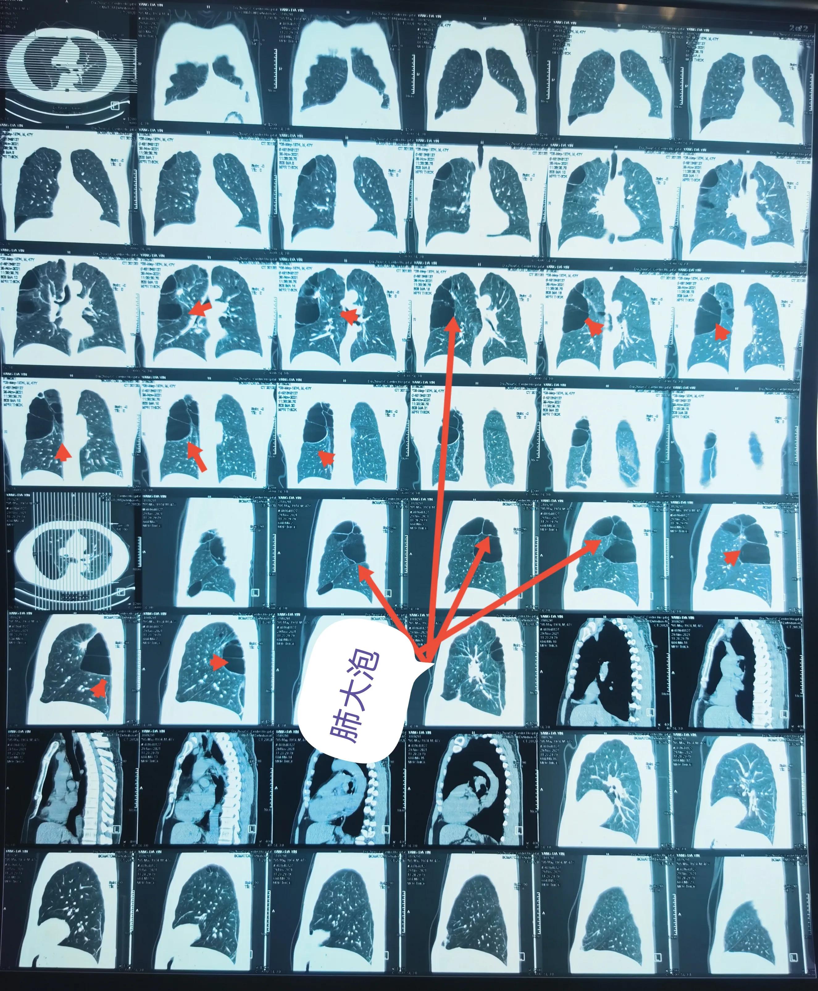 肺大泡产生的原因及治疗方案,肺大泡怎么治疗断根