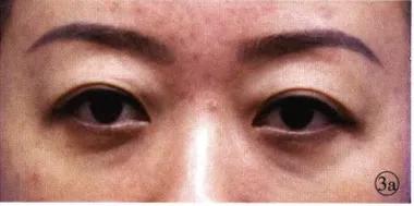 只需知道一招轻松消除显老泪沟,用什么办法能让泪沟修复