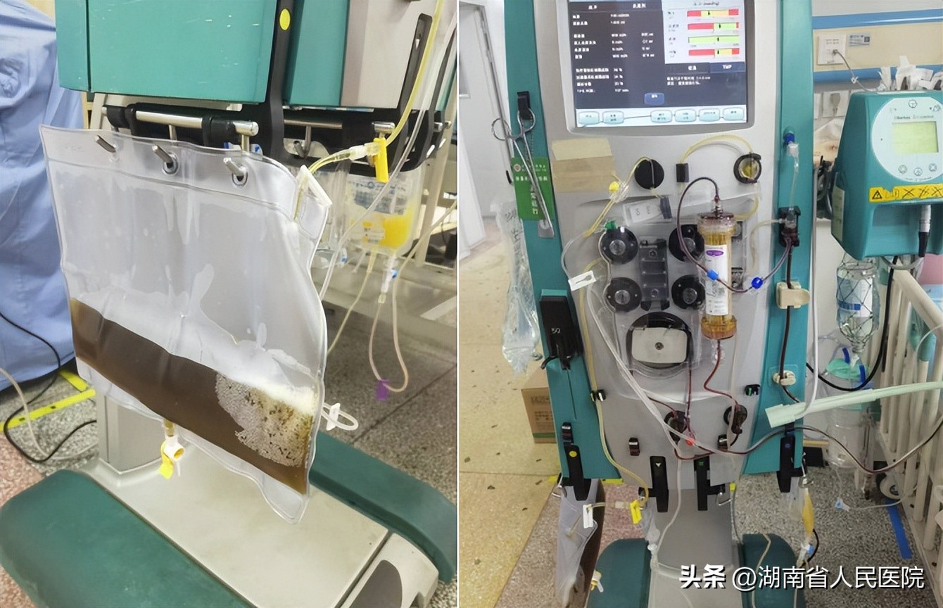 血液净化治疗新冠肺炎效果,连续性血液净化crrt操作视频